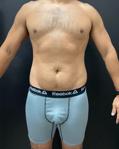 Liposuction Before & After Patient #16500