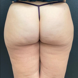 Aveli Before & After Patient #16499
