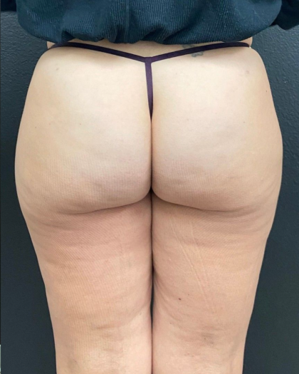 Aveli Before & After Patient #16499
