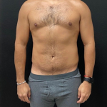 Liposuction Before & After Patient #16500