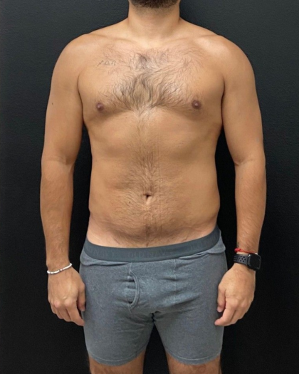 Liposuction Before & After Patient #16500