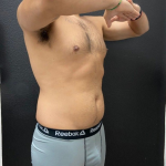 Liposuction Before & After Patient #16500