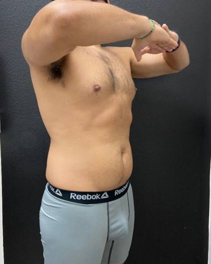 Liposuction Before & After Patient #16500