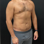 Liposuction Before & After Patient #16500