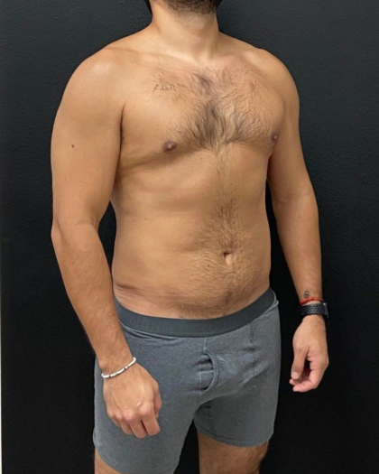Liposuction Before & After Patient #16500