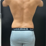 Liposuction Before & After Patient #16500