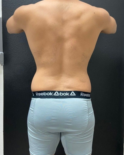Liposuction Before & After Patient #16500