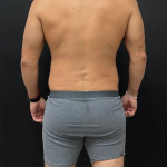 Liposuction Before & After Patient #16500