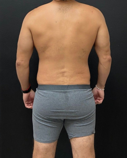 Liposuction Before & After Patient #16500