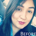 Lip Injections Before & After Patient #16615