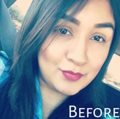 Lip Injections Before & After Patient #16615