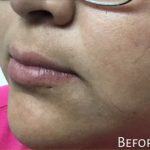 Lip Injections Before & After Patient #16624