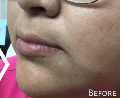 Lip Injections Before & After Patient #16624