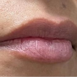 Lip Injections Before & After Patient #16625