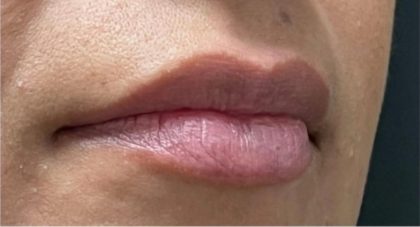 Lip Injections Before & After Patient #16625