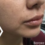 Lip Injections Before & After Patient #16626