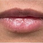Lip Injections Before & After Patient #16627