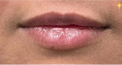 Lip Injections Before & After Patient #16627