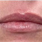 Lip Injections Before & After Patient #16628