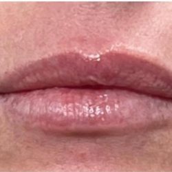 Lip Injections Before & After Patient #16628