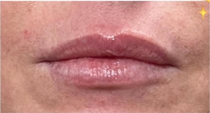 Lip Injections Before & After Patient #16628