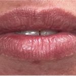 Lip Injections Before & After Patient #16629