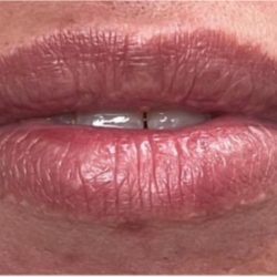 Lip Injections Before & After Patient #16629