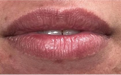 Lip Injections Before & After Patient #16629