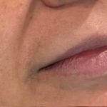 Lip Injections Before & After Patient #16630