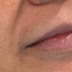 Lip Injections Before & After Patient #16630
