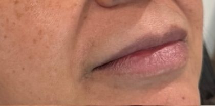 Lip Injections Before & After Patient #16630