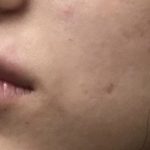 Lip Injections Before & After Patient #16631