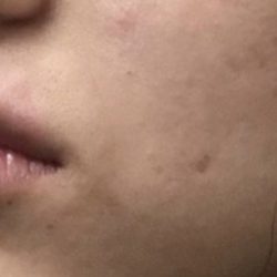 Lip Injections Before & After Patient #16631