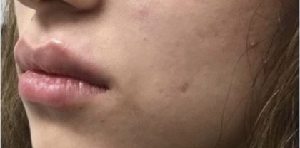 Lip Injections Before & After Patient #16631