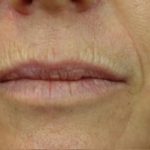Lip Injections Before & After Patient #16632