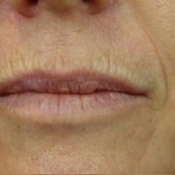 Lip Injections Before & After Patient #16632