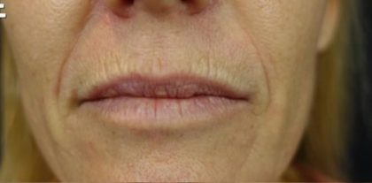 Lip Injections Before & After Patient #16632