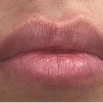 Lip Injections Before & After Patient #16633