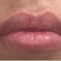 Lip Injections Before & After Patient #16633