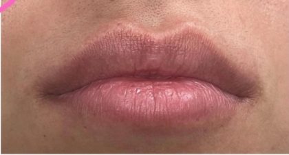 Lip Injections Before & After Patient #16633