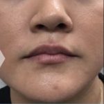 Lip Injections Before & After Patient #16616