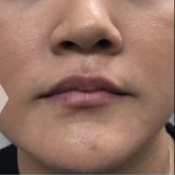Lip Injections Before & After Patient #16616