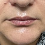 Lip Injections Before & After Patient #16634