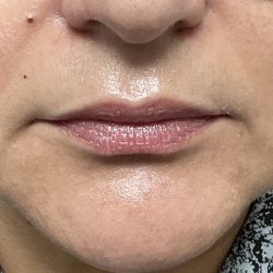 Lip Injections Before & After Patient #16634
