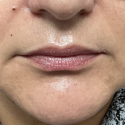 Lip Injections Before & After Patient #16634