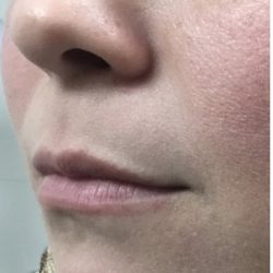 Lip Injections Before & After Patient #16614