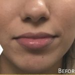 Lip Injections Before & After Patient #16617