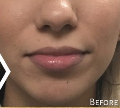 Lip Injections Before & After Patient #16617