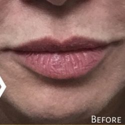 Lip Injections Before & After Patient #16618