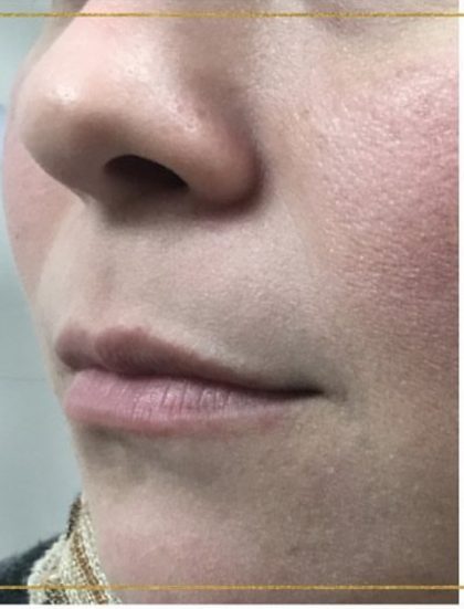 Lip Injections Before & After Patient #16614